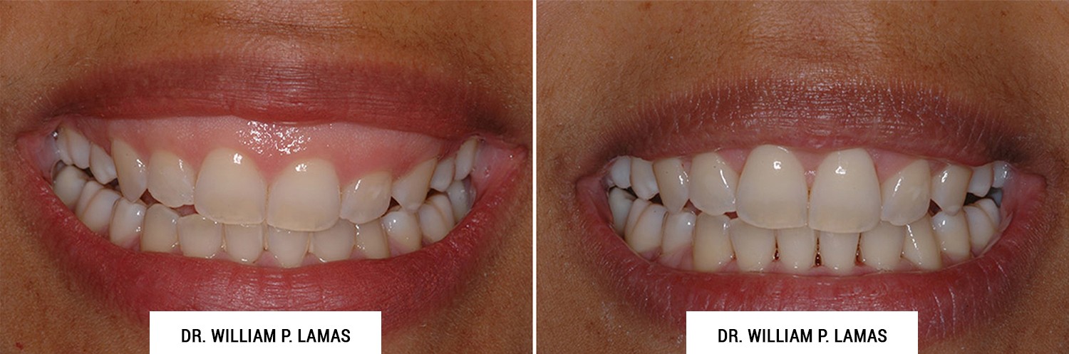 Gummy Smile Correction Before After Photos Dr William Lamas