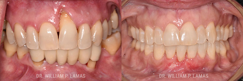 Periodontal Plastic Surgery Before & After Photo - William P. Lamas, DMD - Periodontics & Dental Implants. 