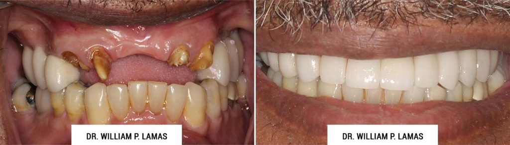All-on-4 Dental Implants Before & After Photo - William P. Lamas, DMD - Periodontics & Dental Implants. Address: 2645 SW 37th Ave Suite 304, Miami, FL 33133 Phone: (305) 440-4114
