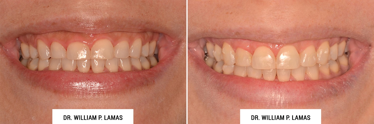 Crown Lengthening Before & After Photos Dr. William Lamas