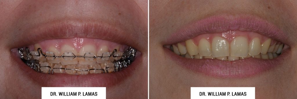 Crown Lengthening Before & After Photo - William P. Lamas, DMD - Periodontics & Dental Implants. Address: 2645 SW 37th Ave Suite 304, Miami, FL 33133 Phone: (305) 440-4114