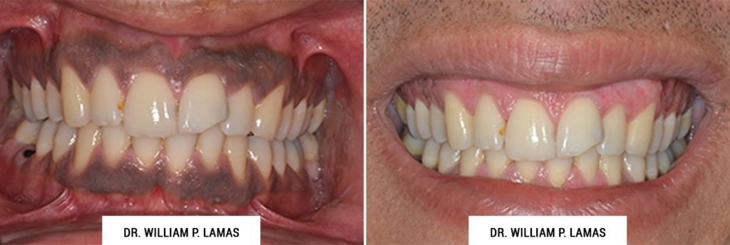 Dark Gum Depigmentation Before & After Photo - William P. Lamas, DMD - Periodontics & Dental Implants. Address: 2645 SW 37th Ave Suite 304, Miami, FL 33133 Phone: (305) 440-4114