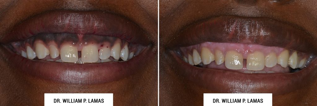 Dark Gum Depigmentation Before & After Photo - William P. Lamas, DMD - Periodontics & Dental Implants. Address: 2645 SW 37th Ave Suite 304, Miami, FL 33133 Phone: (305) 440-4114