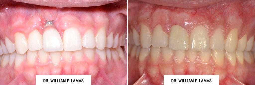 Dental Implants Repair Before & After Photo - William P. Lamas, DMD - Periodontics & Dental Implants. Address: 2645 SW 37th Ave Suite 304, Miami, FL 33133 Phone: (305) 440-4114