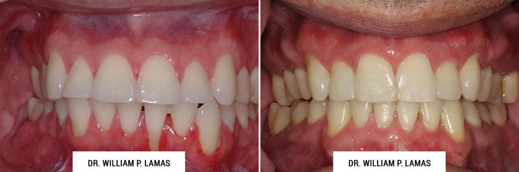 Gum Grafting Treatment Before & After Photo - William P. Lamas, DMD - Periodontics & Dental Implants. Address: 2645 SW 37th Ave Suite 304, Miami, FL 33133 Phone: (305) 440-4114