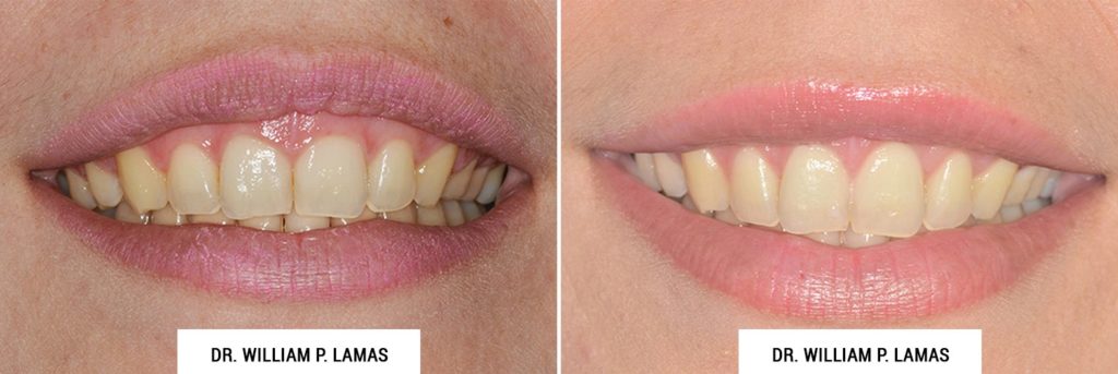 Gummy Smile Correction Before & After Photo - William P. Lamas, DMD - Periodontics & Dental Implants. Address: 2645 SW 37th Ave Suite 304, Miami, FL 33133 Phone: (305) 440-4114