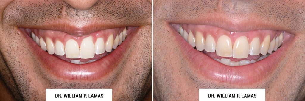 Periodontal Plastic Surgery Before & After Photo - William P. Lamas, DMD - Periodontics & Dental Implants. Address: 2645 SW 37th Ave Suite 304, Miami, FL 33133 Phone: (305) 440-4114