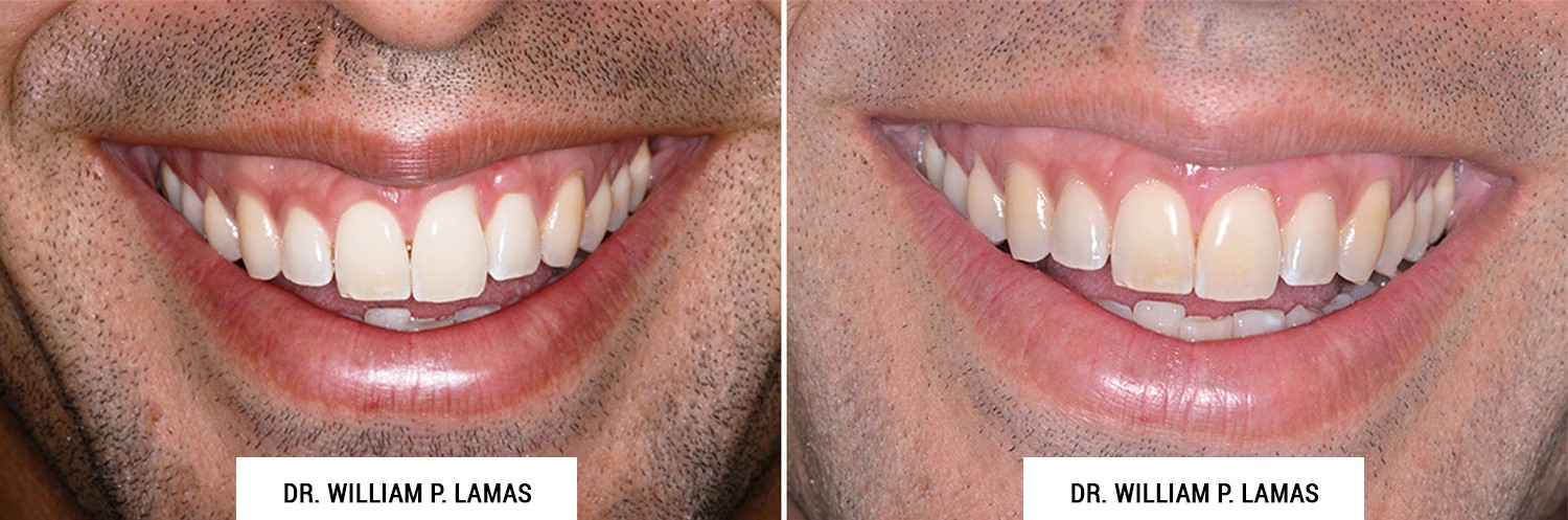 Periodontal Plastic Surgery Before And After Photos Dr William Lamas 