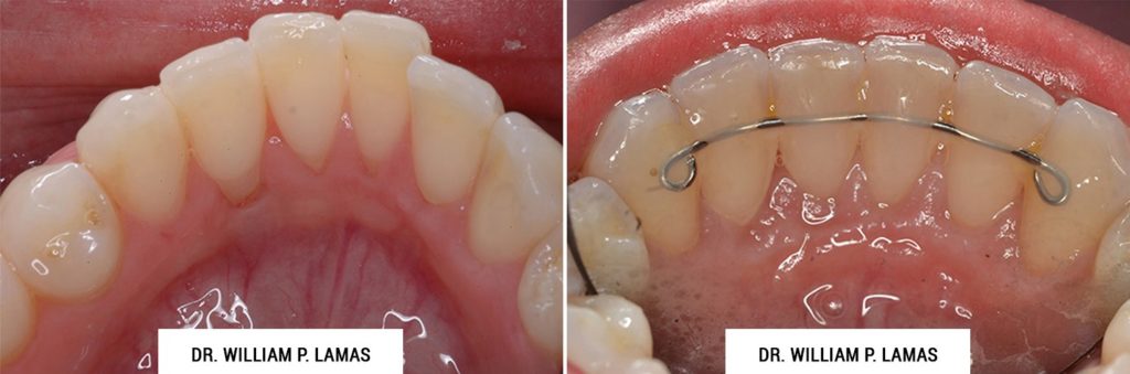 Periodontal Plastic Surgery Before & After Photo - William P. Lamas, DMD - Periodontics & Dental Implants. Address: 2645 SW 37th Ave Suite 304, Miami, FL 33133 Phone: (305) 440-4114