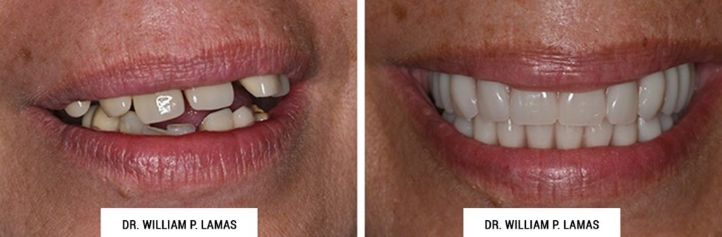 TeethXPress Dental Implants Before & After Photo - William P. Lamas, DMD - Periodontics & Dental Implants. Address: 2645 SW 37th Ave Suite 304, Miami, FL 33133 Phone: (305) 440-4114