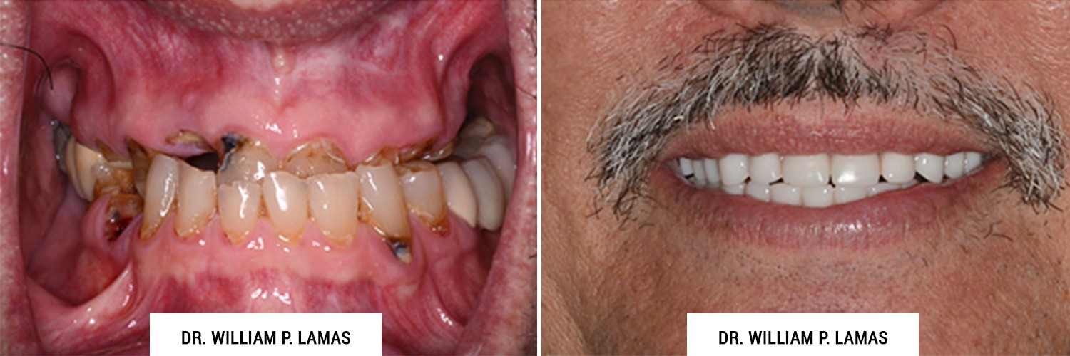 TeethXPress® Before & After Photos Dr. William Lamas