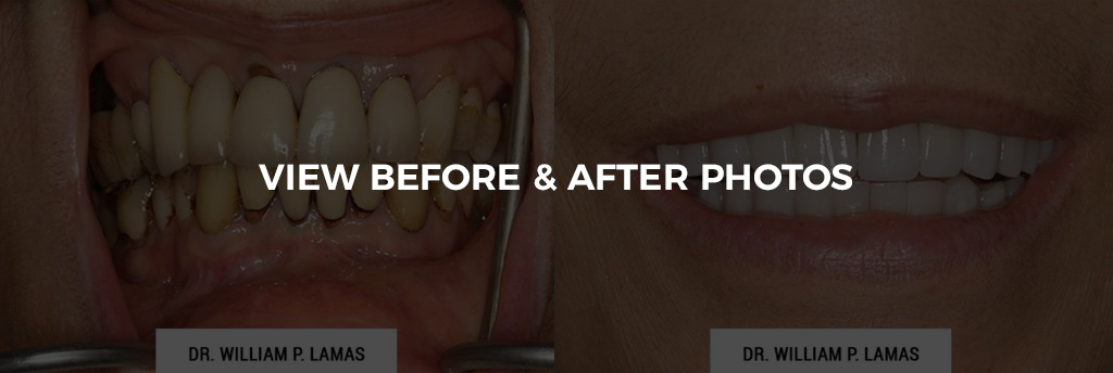 All-on-4 Dental Implants Before & After Photo - William P. Lamas, DMD - Periodontics & Dental Implants. Address: 2645 SW 37th Ave Suite 304, Miami, FL 33133 Phone: (305) 440-4114