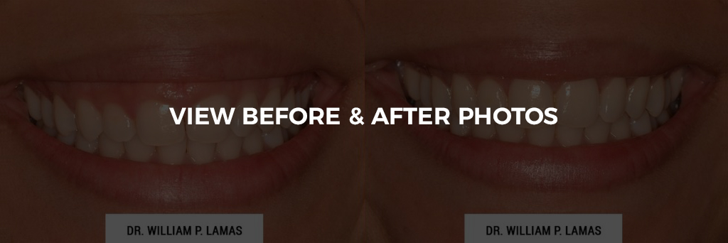Crown Lengthening Before & After Photo - William P. Lamas, DMD - Periodontics & Dental Implants. Address: 2645 SW 37th Ave Suite 304, Miami, FL 33133 Phone: (305) 440-4114