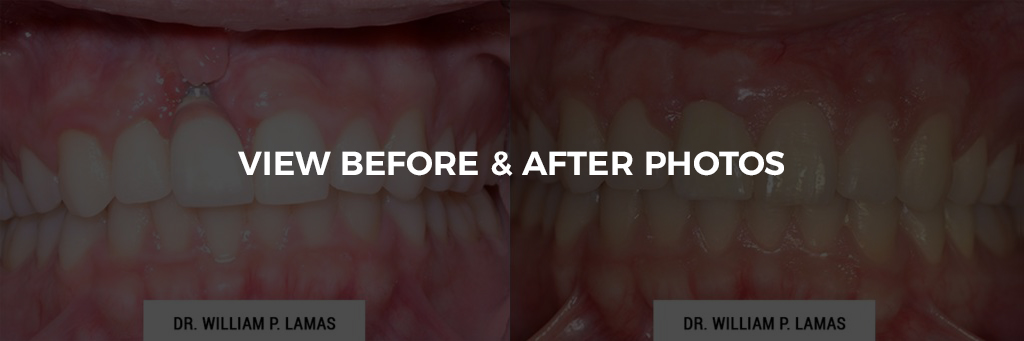 Dental Implants Repair Before & After Photo - William P. Lamas, DMD - Periodontics & Dental Implants. Address: 2645 SW 37th Ave Suite 304, Miami, FL 33133 Phone: (305) 440-4114