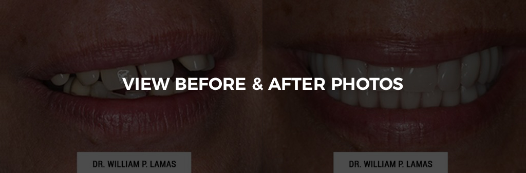 TeethXPress Dental Implants Before & After Photo - William P. Lamas, DMD - Periodontics & Dental Implants. Address: 2645 SW 37th Ave Suite 304, Miami, FL 33133 Phone: (305) 440-4114