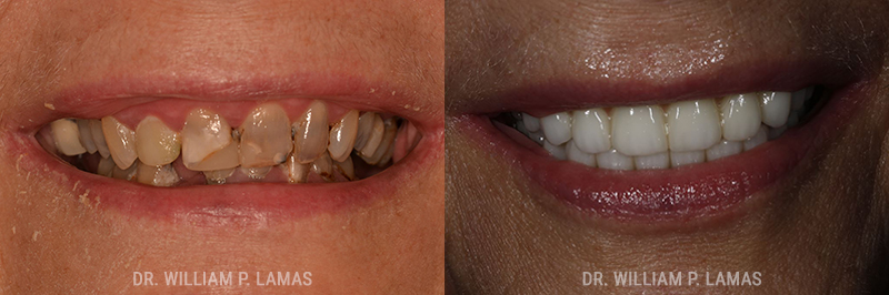 Full Teeth Replacement Before & After Photo - William P. Lamas, DMD - Periodontics & Dental Implants. 