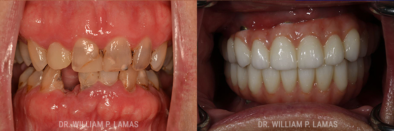 Full Teeth Replacement Before & After Photo - William P. Lamas, DMD - Periodontics & Dental Implants. 