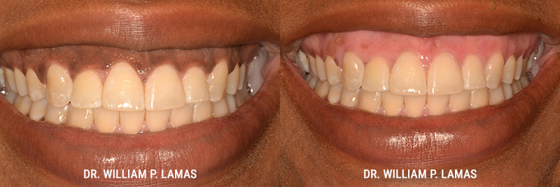 Dark Gum Depigmentation Before & After Photo - William P. Lamas, DMD - Periodontics & Dental Implants. 