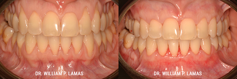 Gum Grafting Treatment Before & After Photo - William P. Lamas, DMD - Periodontics & Dental Implants. 