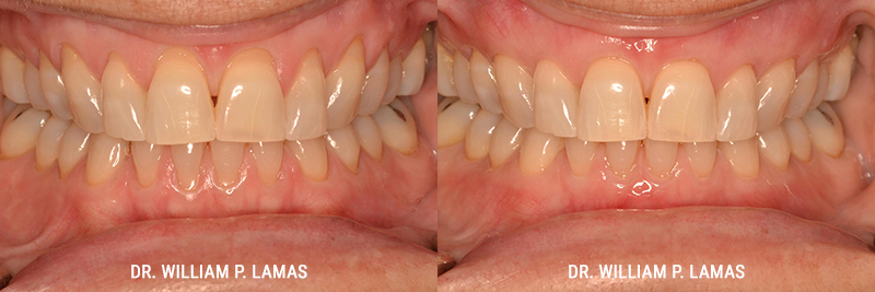 Gum Grafting Treatment Before & After Photo - William P. Lamas, DMD - Periodontics & Dental Implants. 