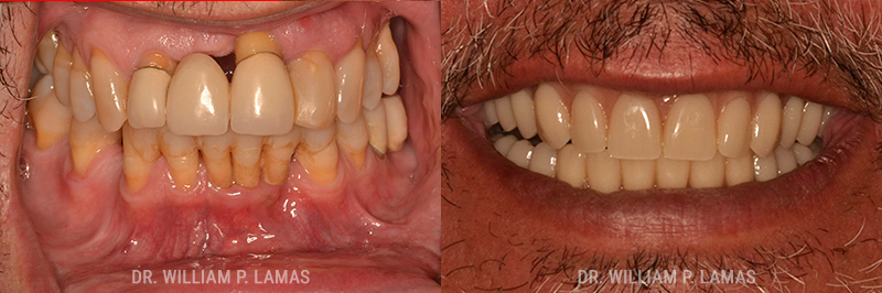 Full Teeth Replacement Before & After Photo - William P. Lamas, DMD - Periodontics & Dental Implants.