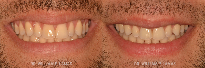 Gum Grafting Treatment Before & After Photo - William P. Lamas, DMD - Periodontics & Dental Implants