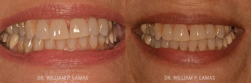Gum Grafting Treatment Before & After Photo - William P. Lamas, DMD - Periodontics & Dental Implants