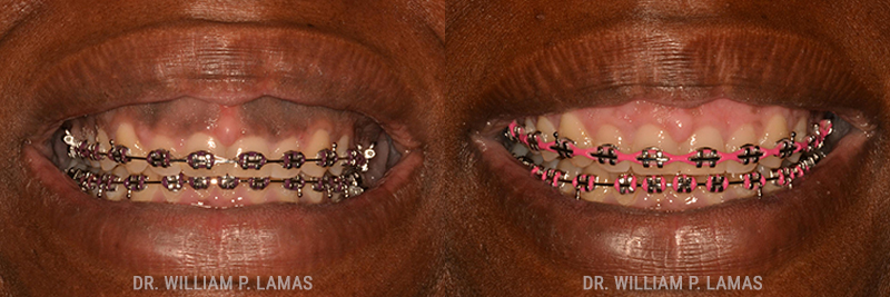 Dark Gum Depigmentation Before & After Photo - William P. Lamas, DMD - Periodontics & Dental Implants. 