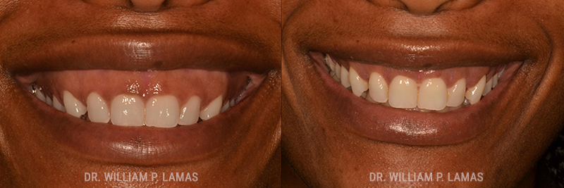 Gummy Smile Correction Before & After Photo - William P. Lamas, DMD - Periodontics & Dental Implants. 