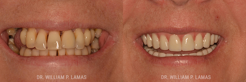 TeethXPress Dental Implants Before & After Photo - William P. Lamas, DMD - Periodontics & Dental Implants.