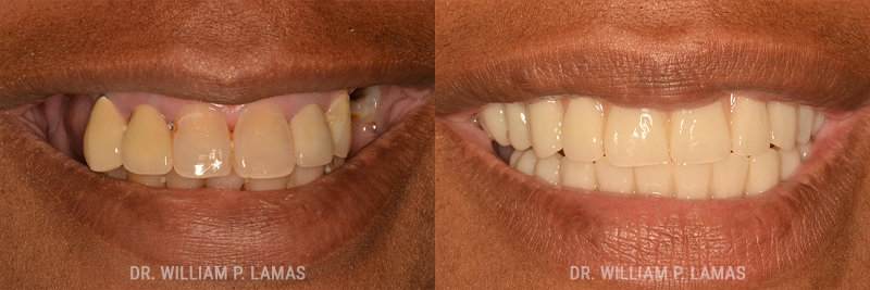 TeethXPress Dental Implants Before & After Photo - William P. Lamas, DMD - Periodontics & Dental Implants. 