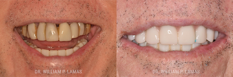 Full Teeth Replacement Before & After Photo - William P. Lamas, DMD - Periodontics & Dental Implants.