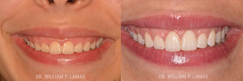  Gummy Smile Correction Before & After Photo - William P. Lamas, DMD - Periodontics & Dental Implants. 