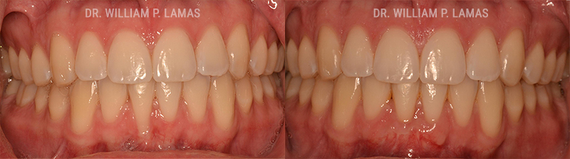 Pinhole Surgical Technique Before & After Photos - William P. Lamas, DMD - Periodontics & Dental Implants.