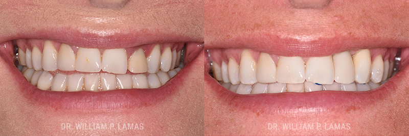 Dental Implants Before & After Photo - William P. Lamas, DMD - Periodontics & Dental Implants. 