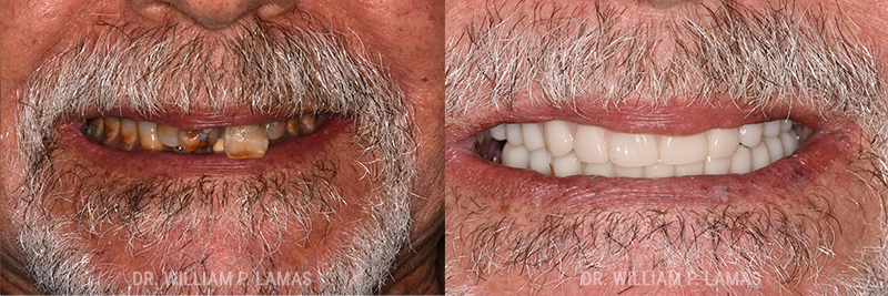 Dental Implants Before & After Photo - William P. Lamas, DMD - Periodontics & Dental Implants.