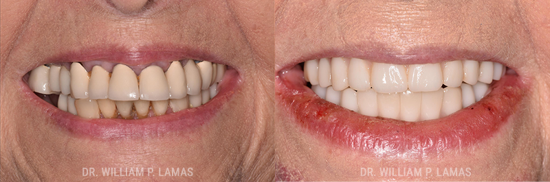 All-on-4 Dental Implants Before & After Photo - William P. Lamas, DMD - Periodontics & Dental Implants. 