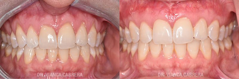 Gum Grafting Treatment Before & After Photo - Dr. Vianca Cabrera
