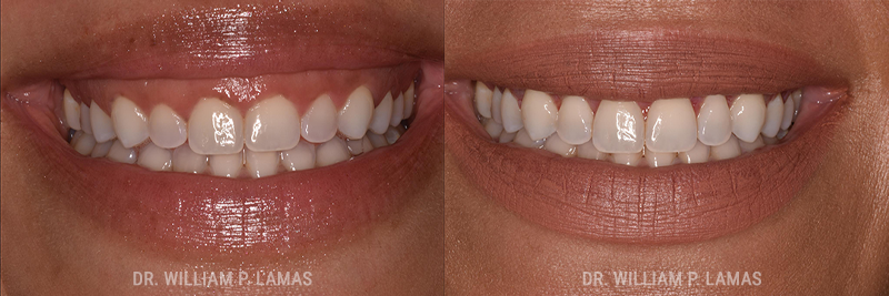 Periodontal Plastic Surgery Before & After Photo - William P. Lamas, DMD - Periodontics & Dental Implants. 