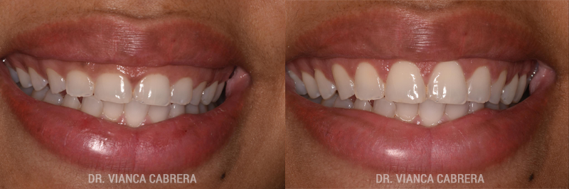 Gummy Smile Correction Before & After Photo - Dr. Vianca Cabrera.