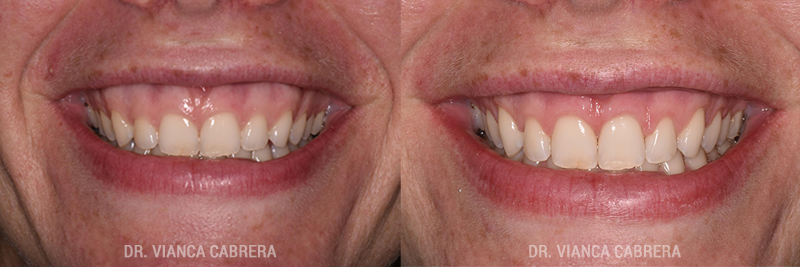 Crown Lengthening Before & After Photo - Dr. Vianca Cabrera.[