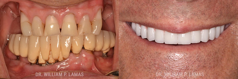 Dental Implants Repair Before & After Photo - William P. Lamas, DMD - Periodontics & Dental Implants. 