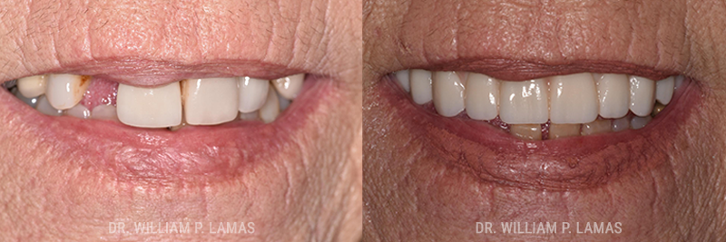 Dental Implants Repair Before & After Photo - William P. Lamas, DMD - Periodontics & Dental Implants.