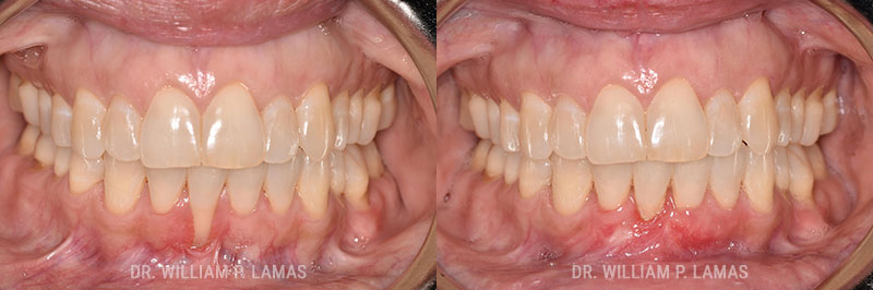 Periodontal Plastic Surgery Before & After Photo - William P. Lamas, DMD - Periodontics & Dental Implants. 